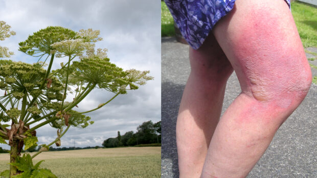 blistered skin on leg and giant hogweed